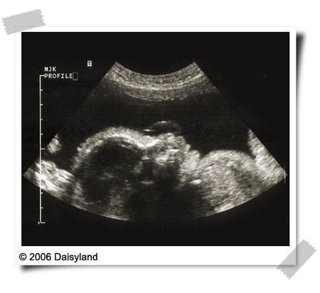 Baby at 28 weeks Baby at 28 weeks